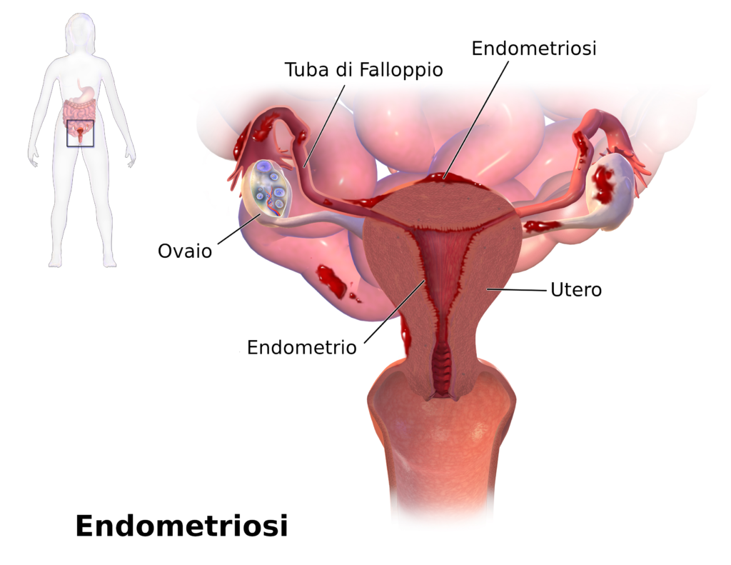 endometriosi organo