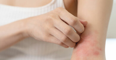 dermatite atopica